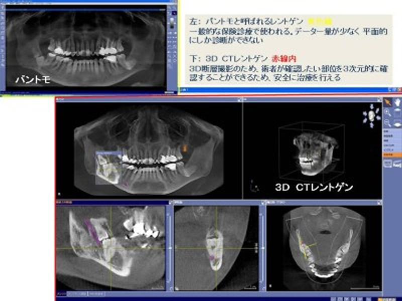 CT画像診断 | アスター歯科新井宿駅前「なるべく抜かない治療」