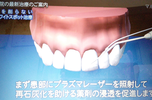 ホワイトスポット処置 | 北区 十条 マルシェ歯科