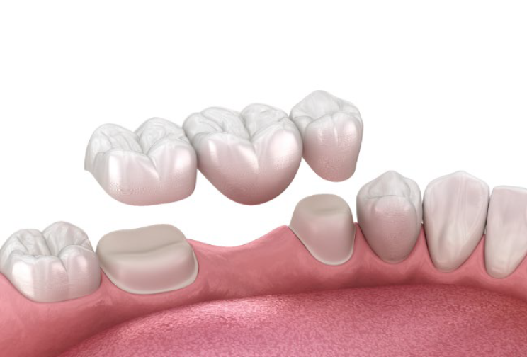 ブリッジ治療 | 川口 新井宿駅前 アスター歯科