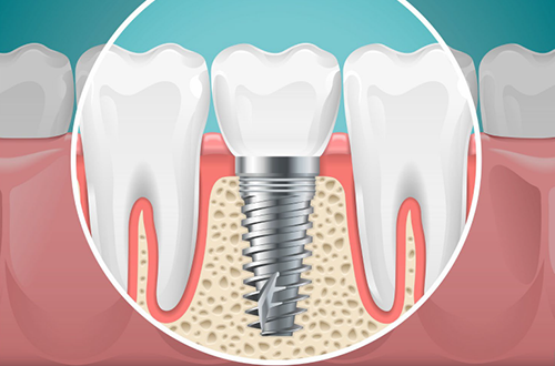 インプラント歯科 | 川口 新井宿駅前 アスター歯科